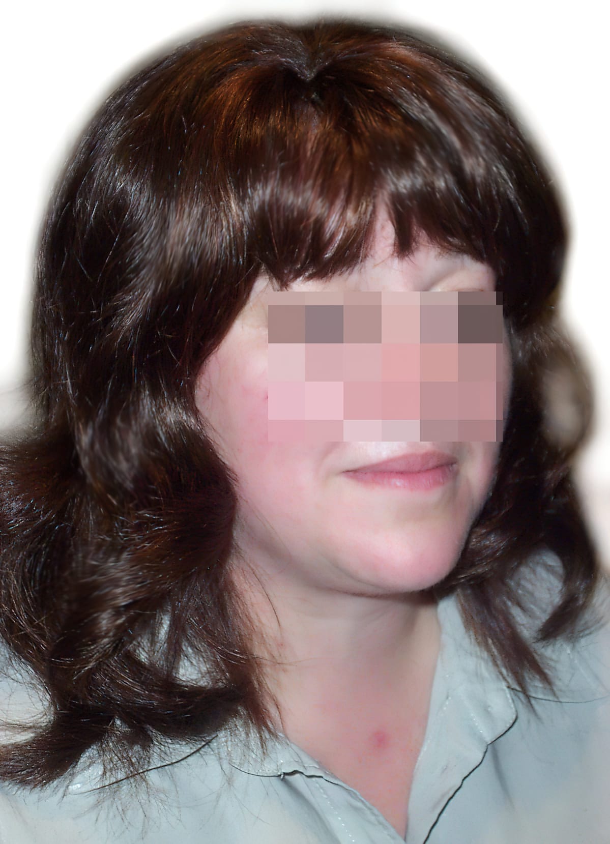 After Picture - Trichotillomania Cosmetic Fix